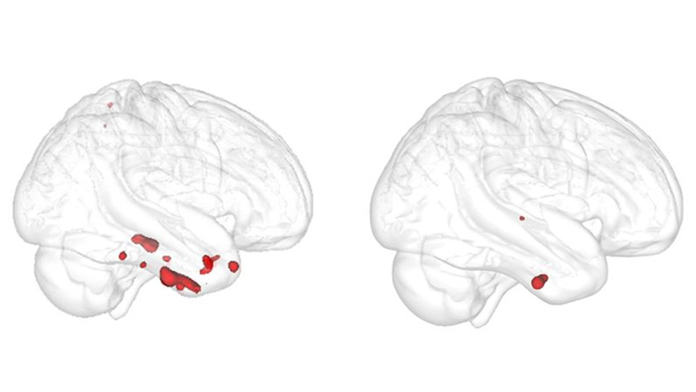 A study supported by Western’s BrainsCAN demonstrates how a subcortical brain area is impacted by early degeneration that leads to Alzheimer’s disease.