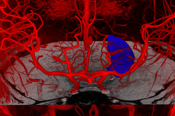 A brain image highlighting the hippocampus in blue.