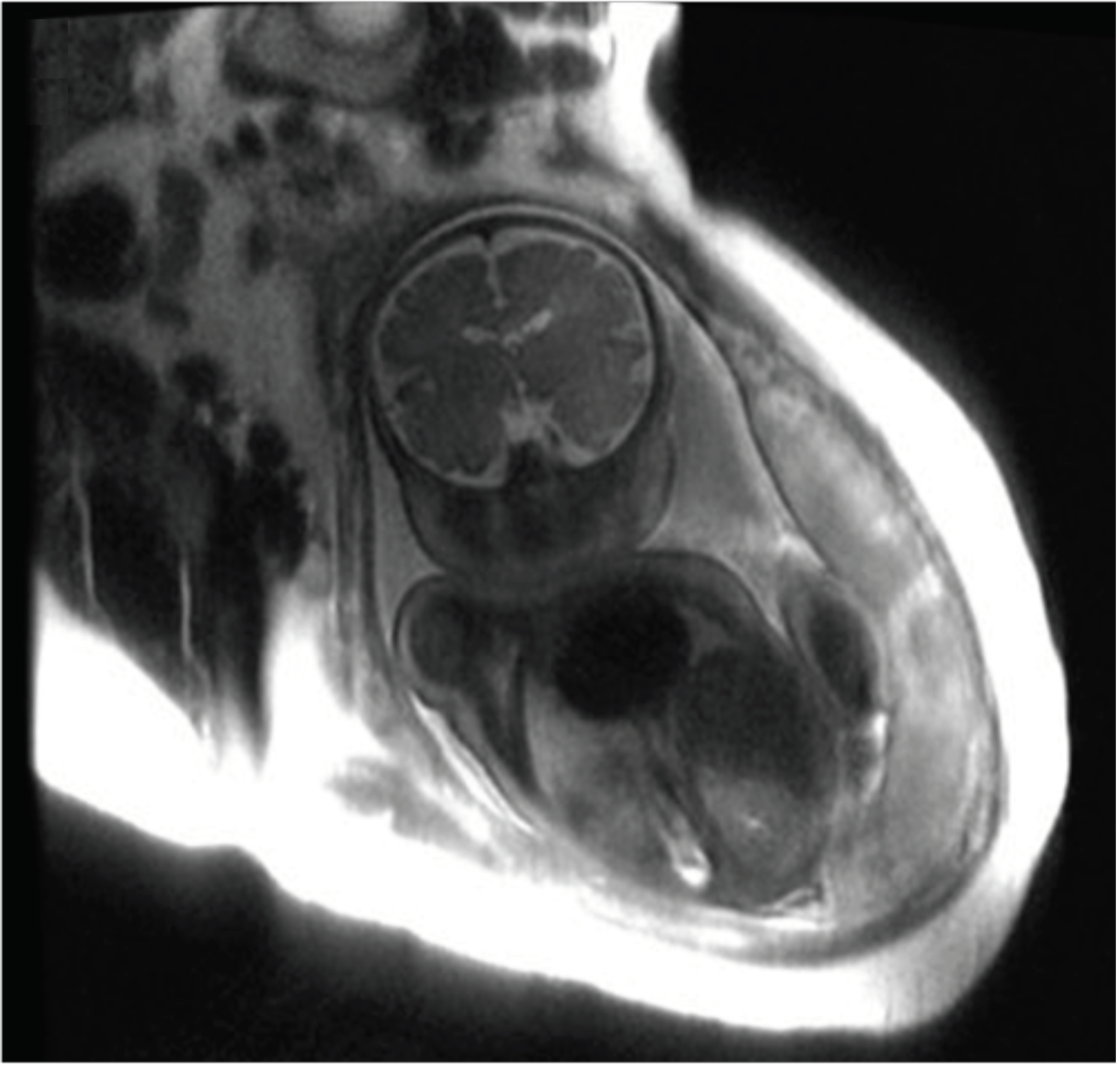 Fetal brain MRI acquired by research team